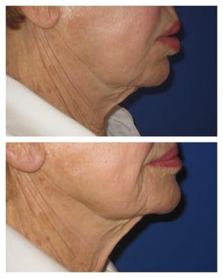 Before and After of Fractora Firm