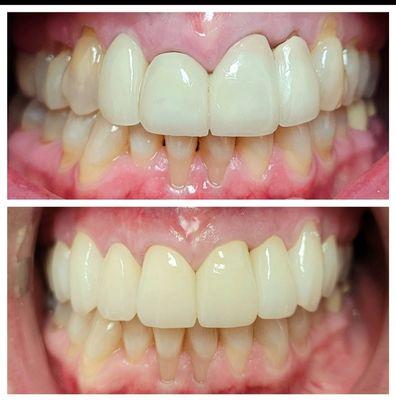 Upper New Crowns with gum tissue Scalloping.