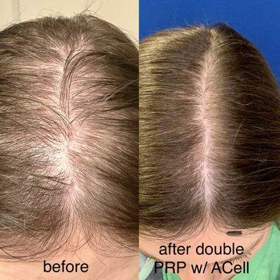 Dr. Tracy is an expert in  hair PRP.