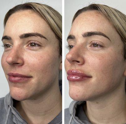 Lip enhancement