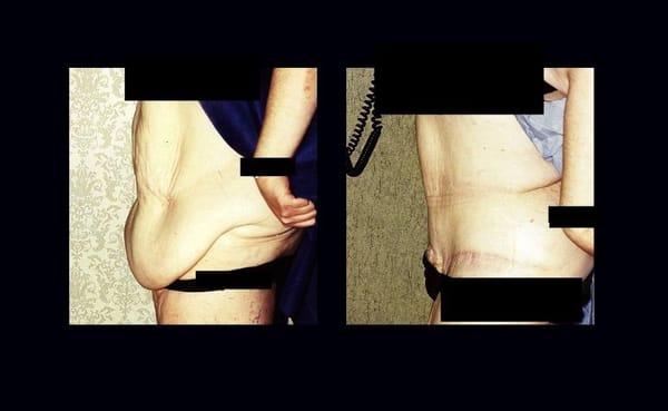 Abdominoplasty