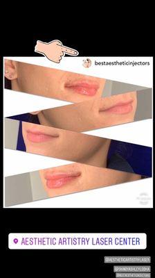 Amazing lips and recognized by @bestaestheticinjectors for the awesome before/after pic