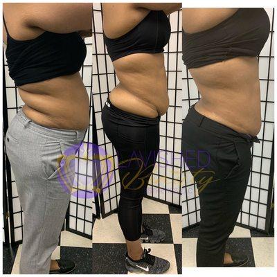 Lipo Cavitation Body Contour (7 Sessions Complete)