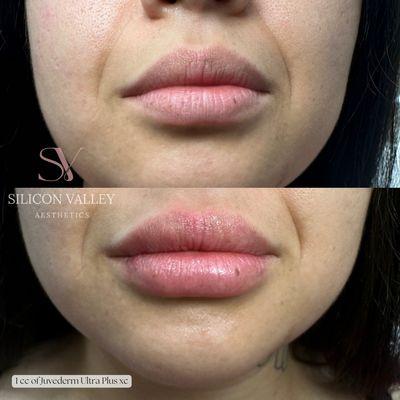 Our bestie had 1 cc of Juvederm Ultra plus xc, expertly done by SVA's perfectionist Thao!