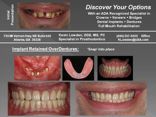 Implant OverDentures