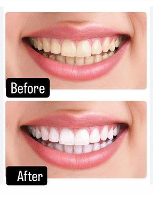 Teeth whitening even for the most sensitive