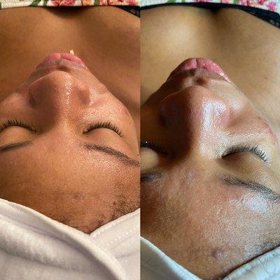 Before and after Signature Spa Facial