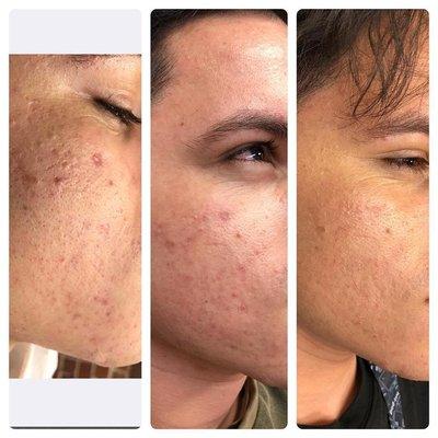 PRP Acne Scar Treatment- 3 Sessions