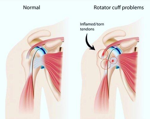 Stem cell therapy at Stemcellix cal help with a range of shoulder conditions!