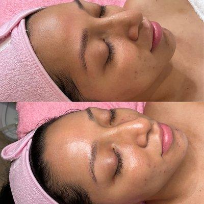 Microdermabrasion facial