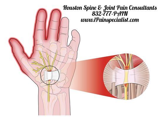 Carpal tunnel doctors near me. We treat your tingling, numbness in hand along with achy sensation in forearm