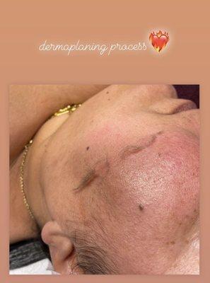 Dermaplaning