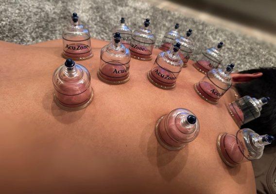 First time cupping - game changer!