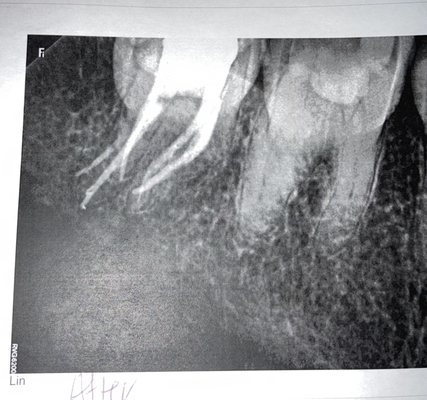 The root canal completed by Forrest lake Endontist but unfortunately Kris Johnson poked into my jawline.