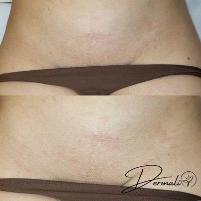 Brazilian Laser Hair Removal after 6 treatments