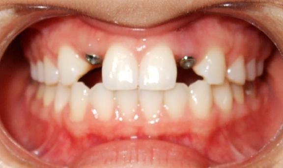 Before placement of 2 dental implants