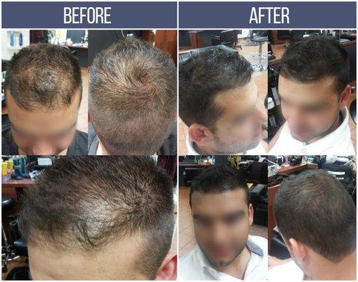 Scalp Micro-pigmentation Camouflage