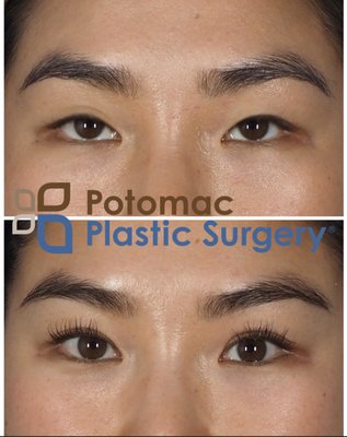 Upper eyelid surgery by Dr. Chaboki of Potomac Plastic Surgery DC