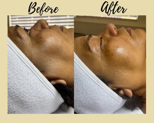 Custom Facial focusing on Pigmentation and Aging look at that Glow!