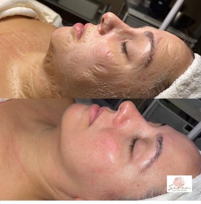 Super protein firming mask during and after.