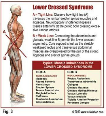 A root cause of Sciatica