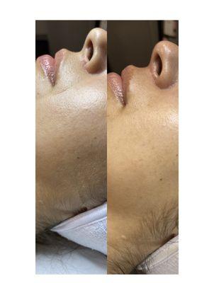 Before & After Dermaplane