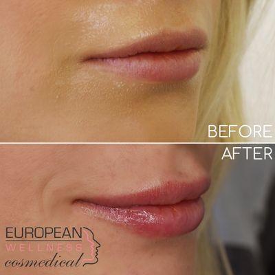 Beautiful Lips! Before and After.