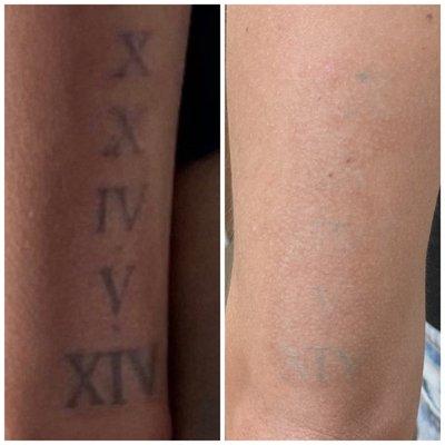 St Pete Tattoo Removal