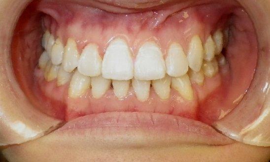 After Treatment - Underbite