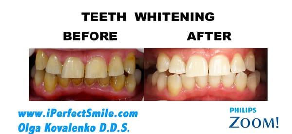 Done on 8/1/14.  A short session using Zoom Teeth Whitening.