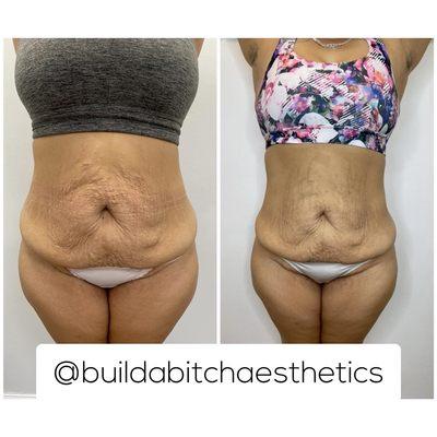 2 sessions of body contouring !