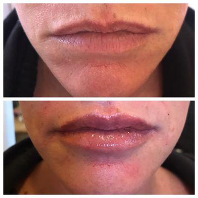 Restylane injections in upper and lower lips. Before (top) and after (bottom).