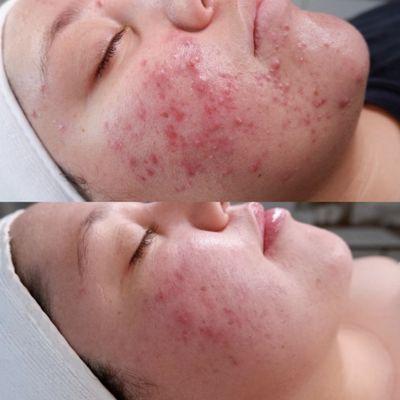 DMK Acne Skin Revision