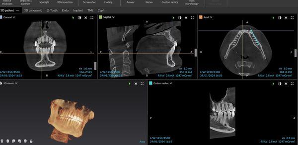 CBCT scans allow for 3 dimensional analysis and diagnosis!