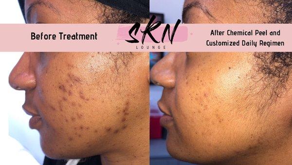 Acne and discoloration before & after our Rejuvenating Chemical Peel