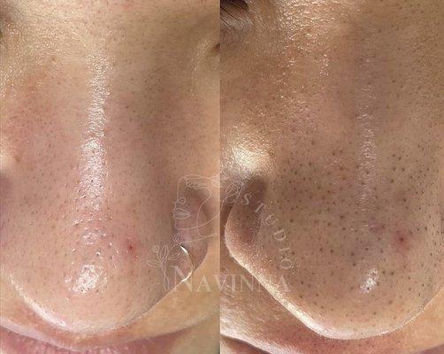 Hydrafacial