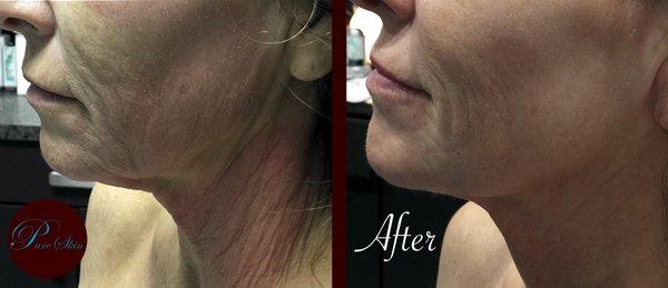 Micro-needling after two treatments.