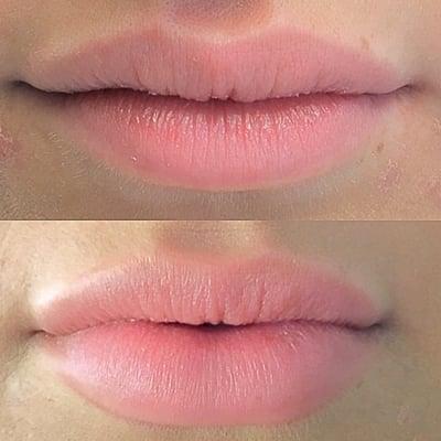 FDA approved Juvederm lip filler, done by Dr. Guy! Natural, subtle, beautiful enhancements are our absolute favorite!