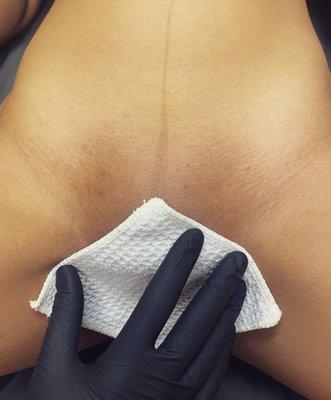 Brazilian Sugaring Hair Removal