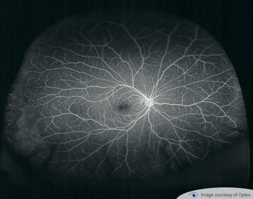 optomap image with Fluorescein Angiography (FA)