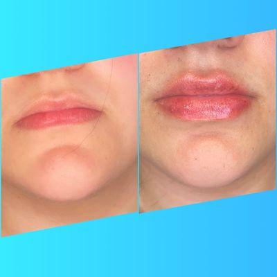 Lip Filler - 1 ML