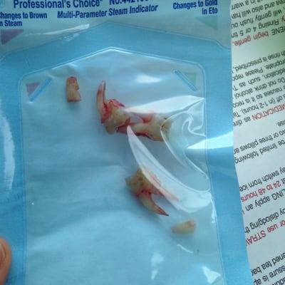 Pretty intact wisdom tooth extraction!