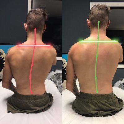 Before and after 60 min treatment for spinal and shoulder girdle alignment