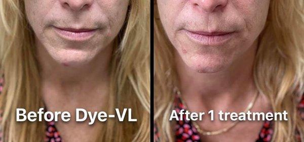 Dye-VL is used to reduce skin pigmentation. Tired of sun damage? Let us help you correct it