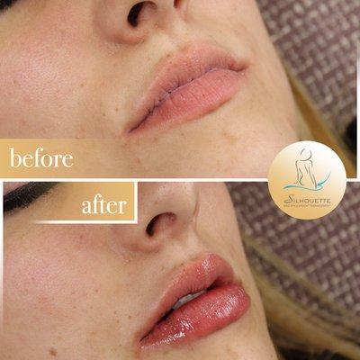 Natural looking lip filler with the cannula technique.