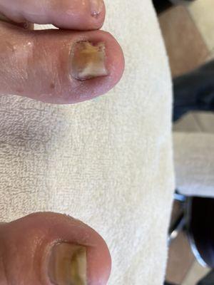 Chemo toe damage, I needed extra help!