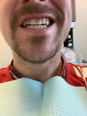 Here is a before. Dentist just numbed me. And I didn't feel the needle. I'll post and after in about an hour.