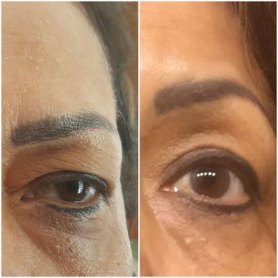 Slight brow lift with microneedling