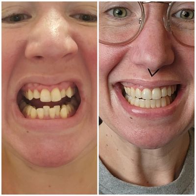 Invisalign: July 2022 to March 2024