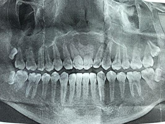 X-ray of wisdom teeth